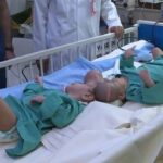 Saudi Arabia , Cojoined Twins